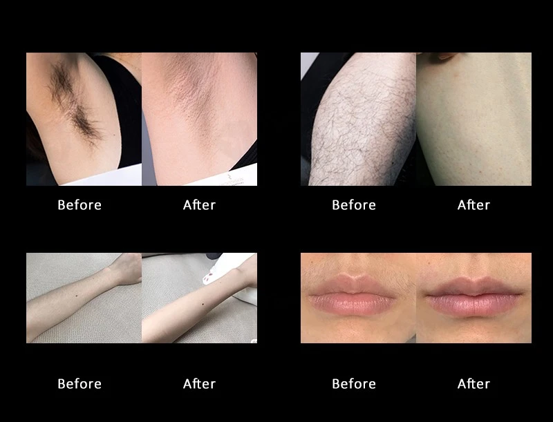 4 Wavelength Diode Laser Hair Removal Machine – Professional, Intelligent & Fully Customizable | MNLT Factory China high quality