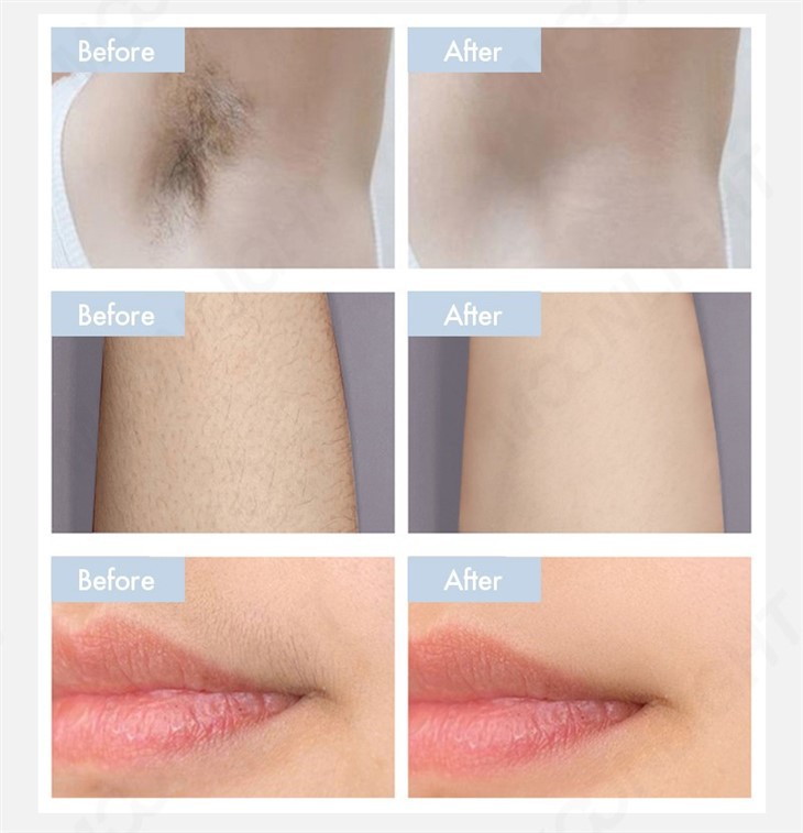 Dual Screen Laser Hair Removal Machine